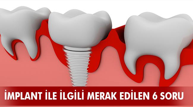 İMPLANT İLE İLGİLİ MERAK EDİLEN 6 SORU
