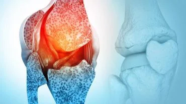 Kemik Erimesi Erken Dönemde Fark Edilebilir!